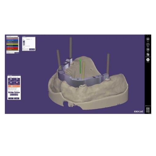 Modul exocad Bar