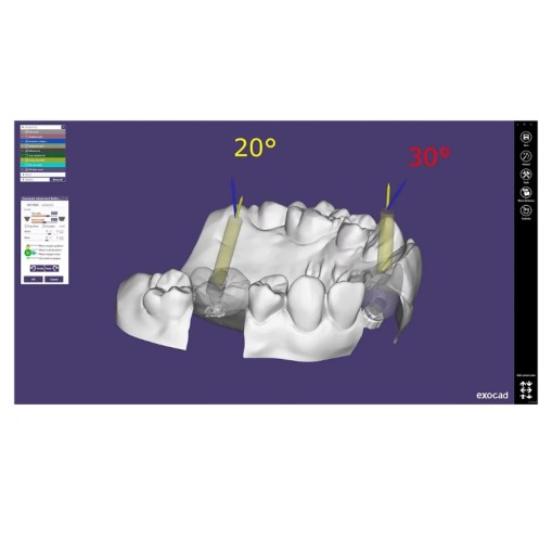 Modul exocad Implant